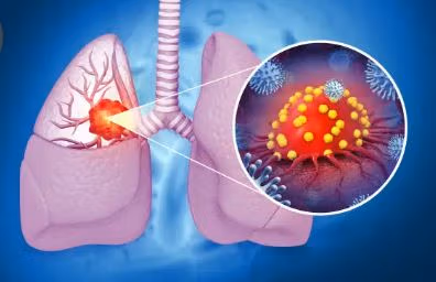 肺癌顯示圖